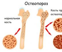 Диагностика остеопороза: лабораторные анализы, маркеры, виды обследований и тесты Анализ на остеопороз в инвитро