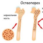 Diagnose von Osteoporose: Labortests, Marker, Untersuchungsarten und Tests. Analyse auf Osteoporose in vitro