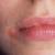 口角の咬傷：原因、ひび割れた唇の治療